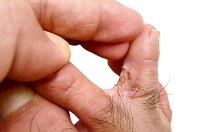 Athlete's Foot Is a Common Fungal Infection