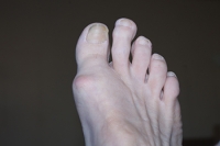 Problems Caused by a Longer Second Toe